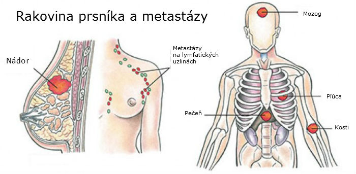 prostata metastázy forum)