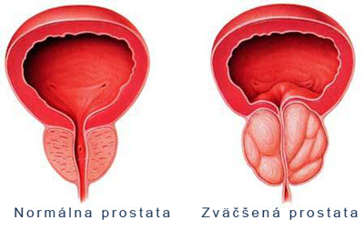 Az ureablazmus krónikus prosztatitis Prostatit 60 éves